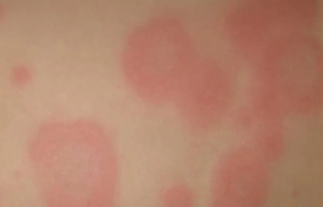 Erythema Multiform - Presentation by Dr. Yeung Ho Hong(楊浩康)