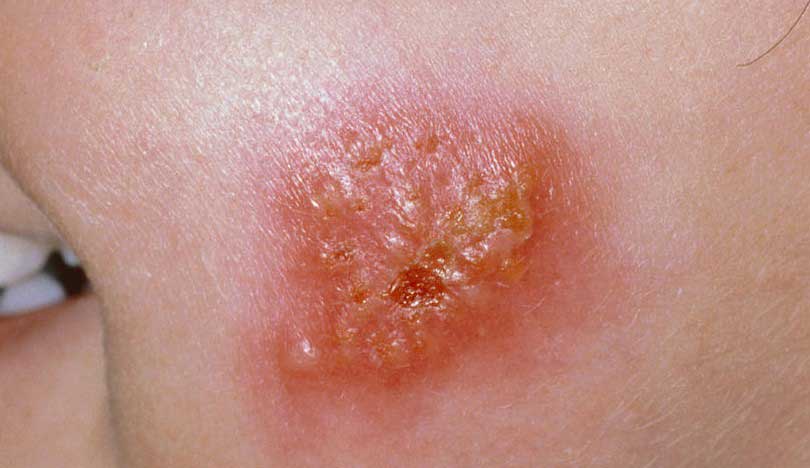 Impetigo - Presentation by Dr. Yeung Ho Hong(楊浩康)