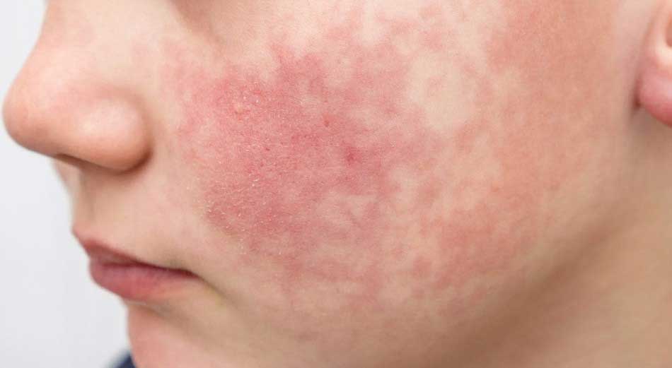 Slapped cheek syndrome - Presentation by Dr. Yeung Ho Hong(楊浩康)
